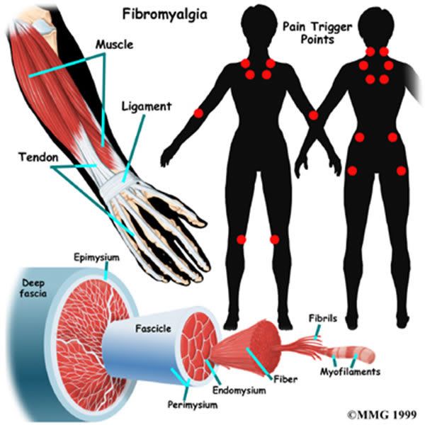 fibromialgia.jpg